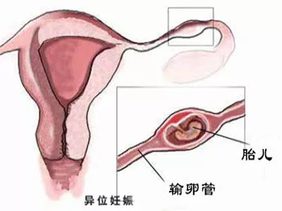 在常州做试管婴儿真的可以避免宫外孕吗？